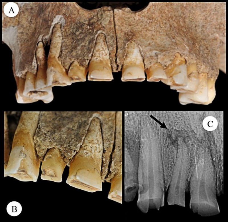 Los daños en los dientes sugieren que se usaron para sujetar la correa de la prótesis durante muchos años.